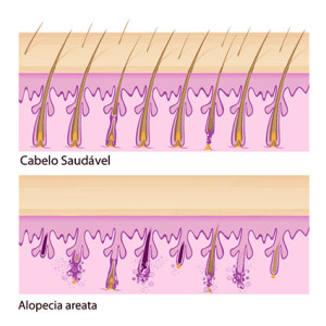 alopecia aerata