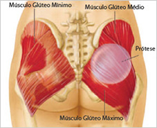 aumento de gluteos