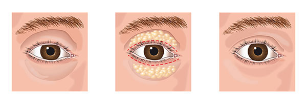 cirurgia de palpebra