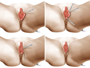 cirurgia-intima