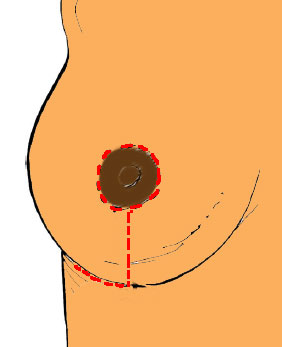 mamoplastia L