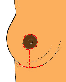 mamoplastia em T invertido