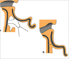 otoplastia