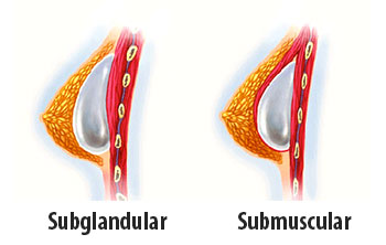 PRÓTESE DE SILICONE - Cirurgia Plástica | DR. FABRICIO RIBEIRO