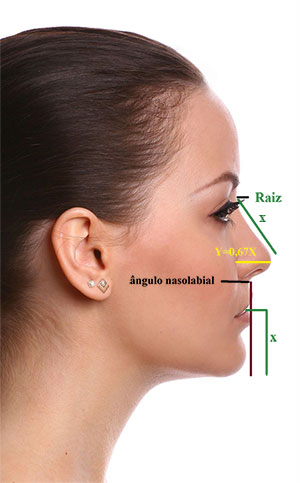 rinoplastia lateral