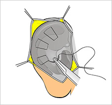 sutura otoplastia