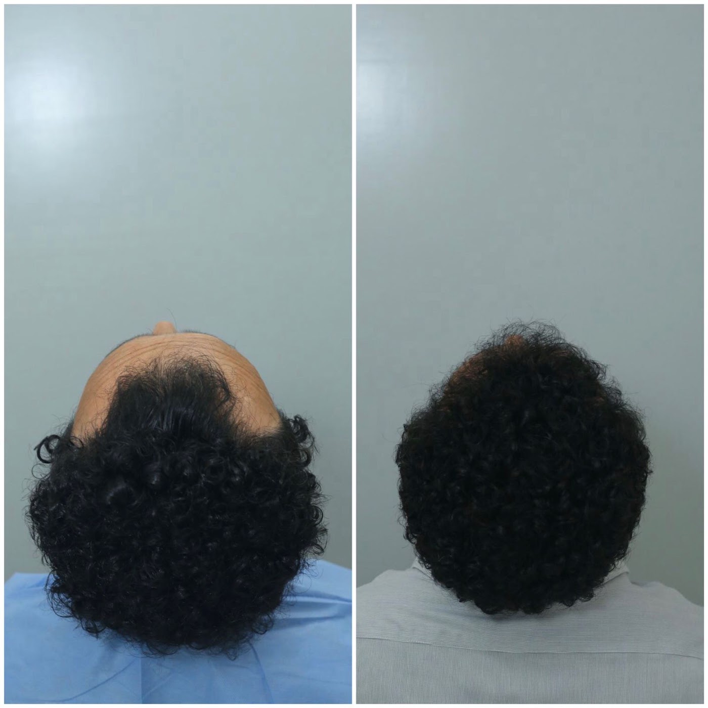 Antes e depois do transplante capilar de Agnaldo Soares