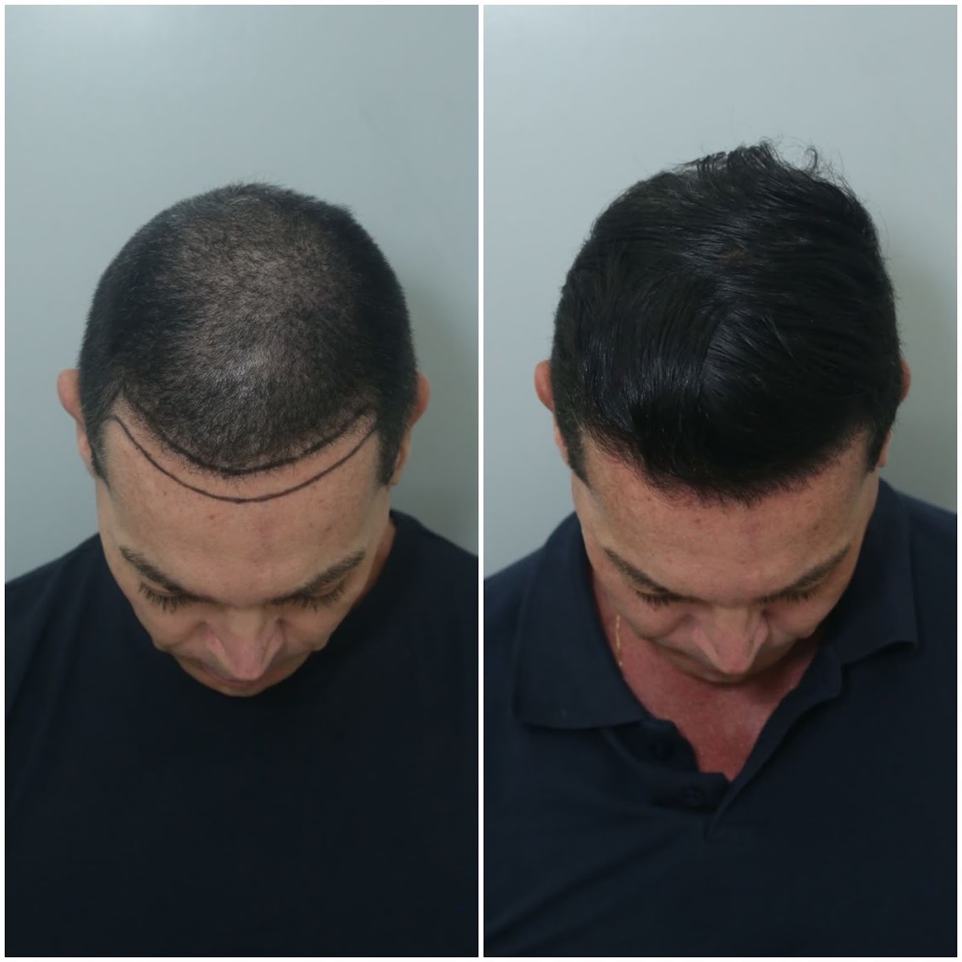 Antes e depois do transplante capilar de Beto Leão
