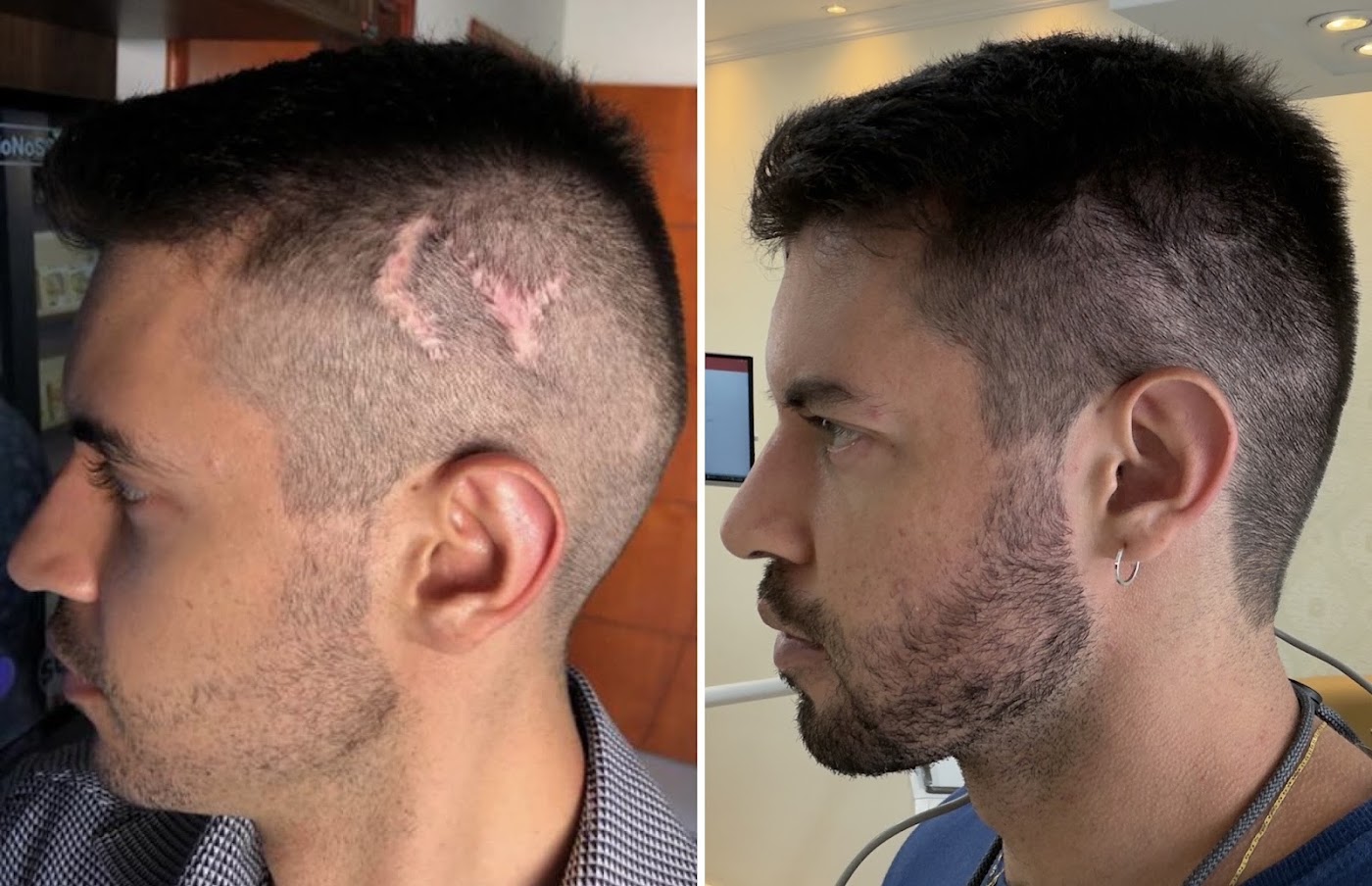 Antes e depois do transplante capilar de Diego Rosa