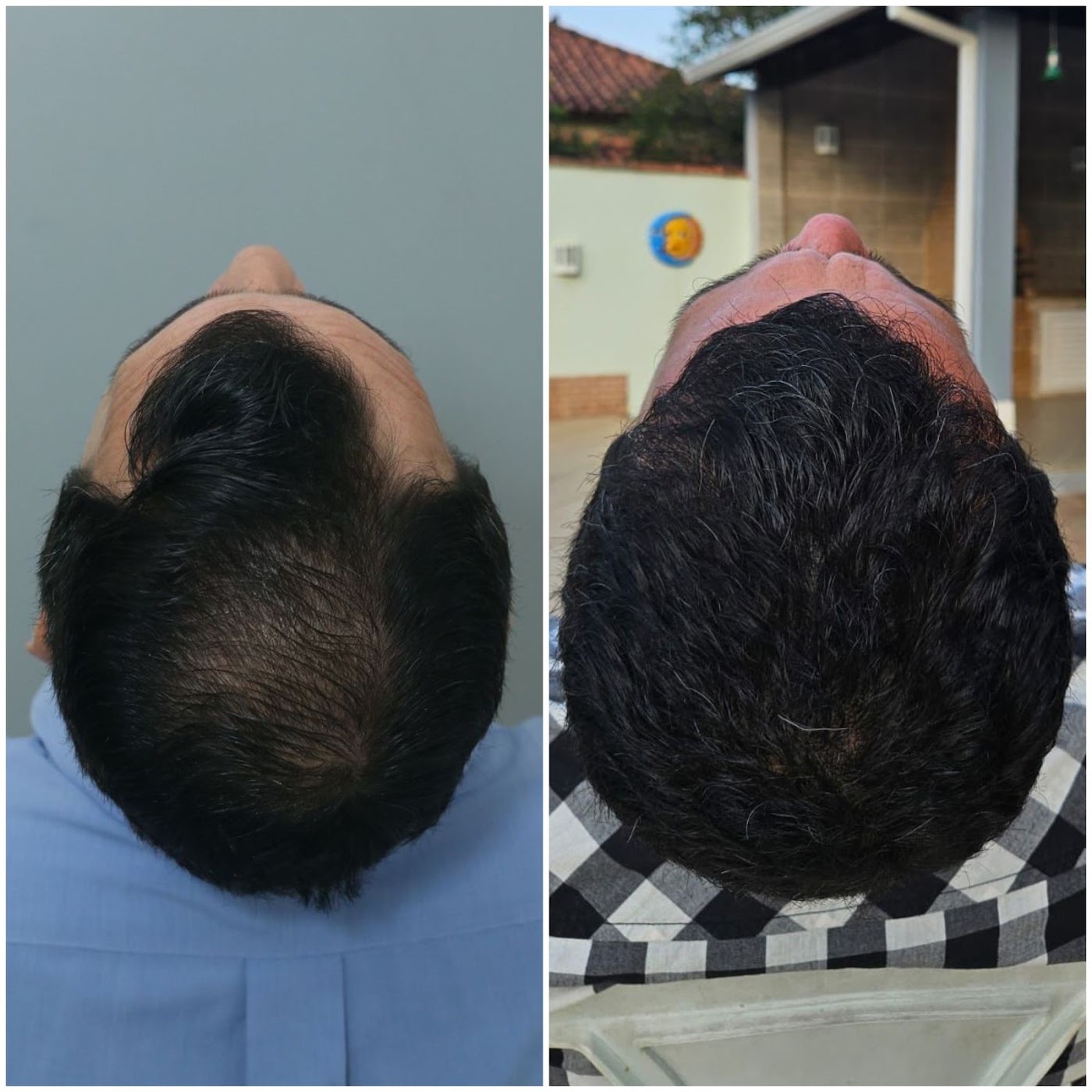 Antes e depois do transplante capilar de Flavio Waltz