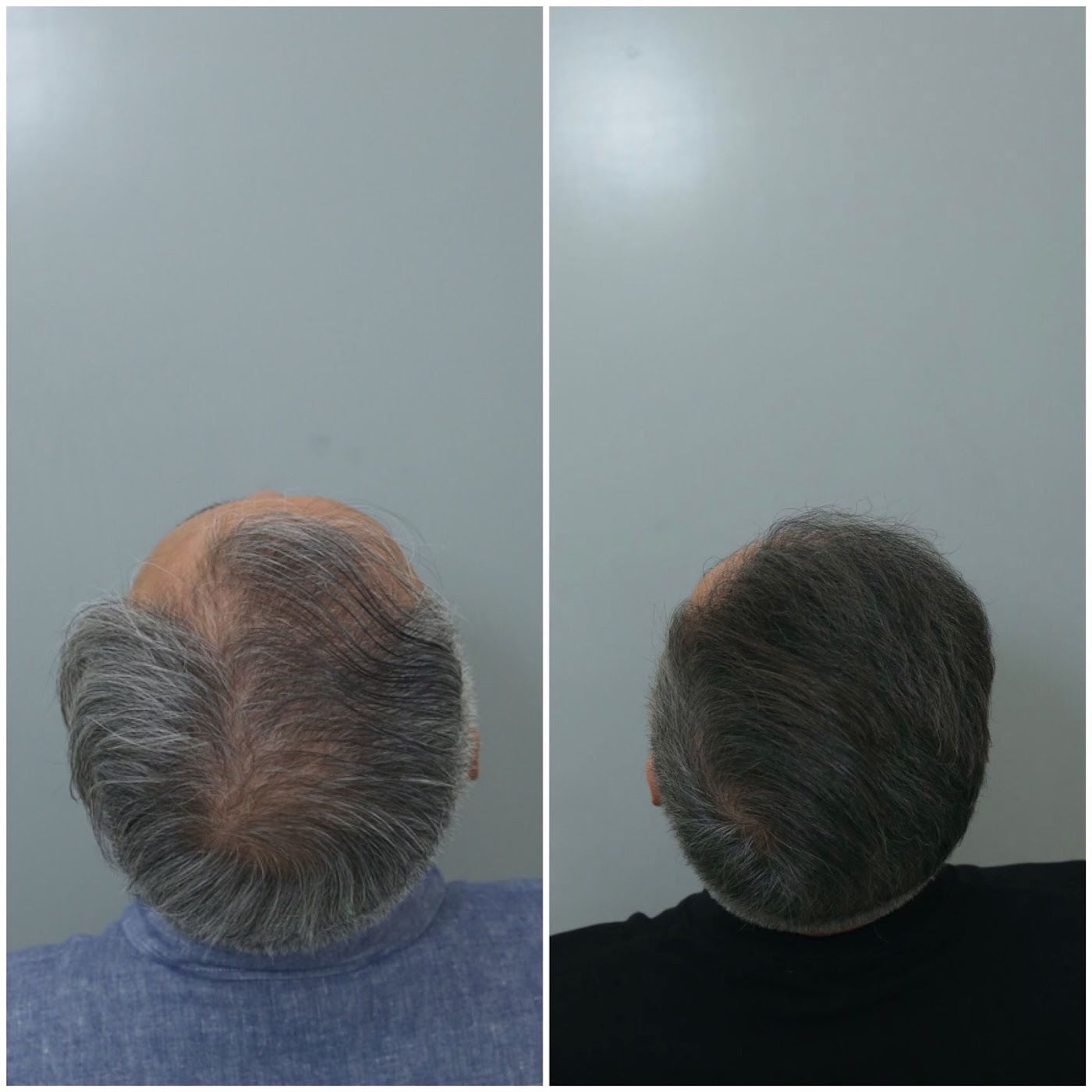 Antes e depois do transplante capilar de Pr Marcelo Ferreira