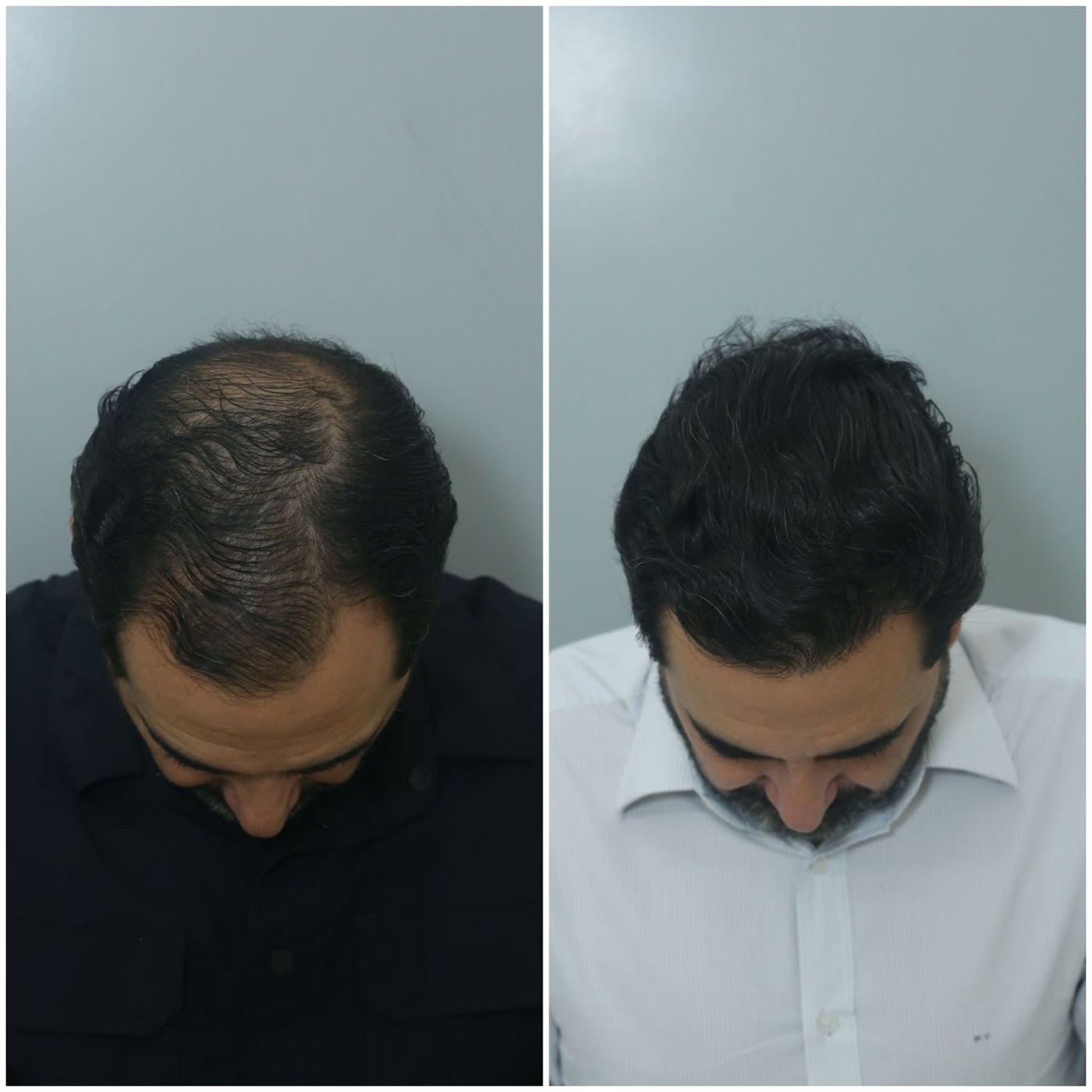 Antes e depois do transplante capilar de Marcio Tiene