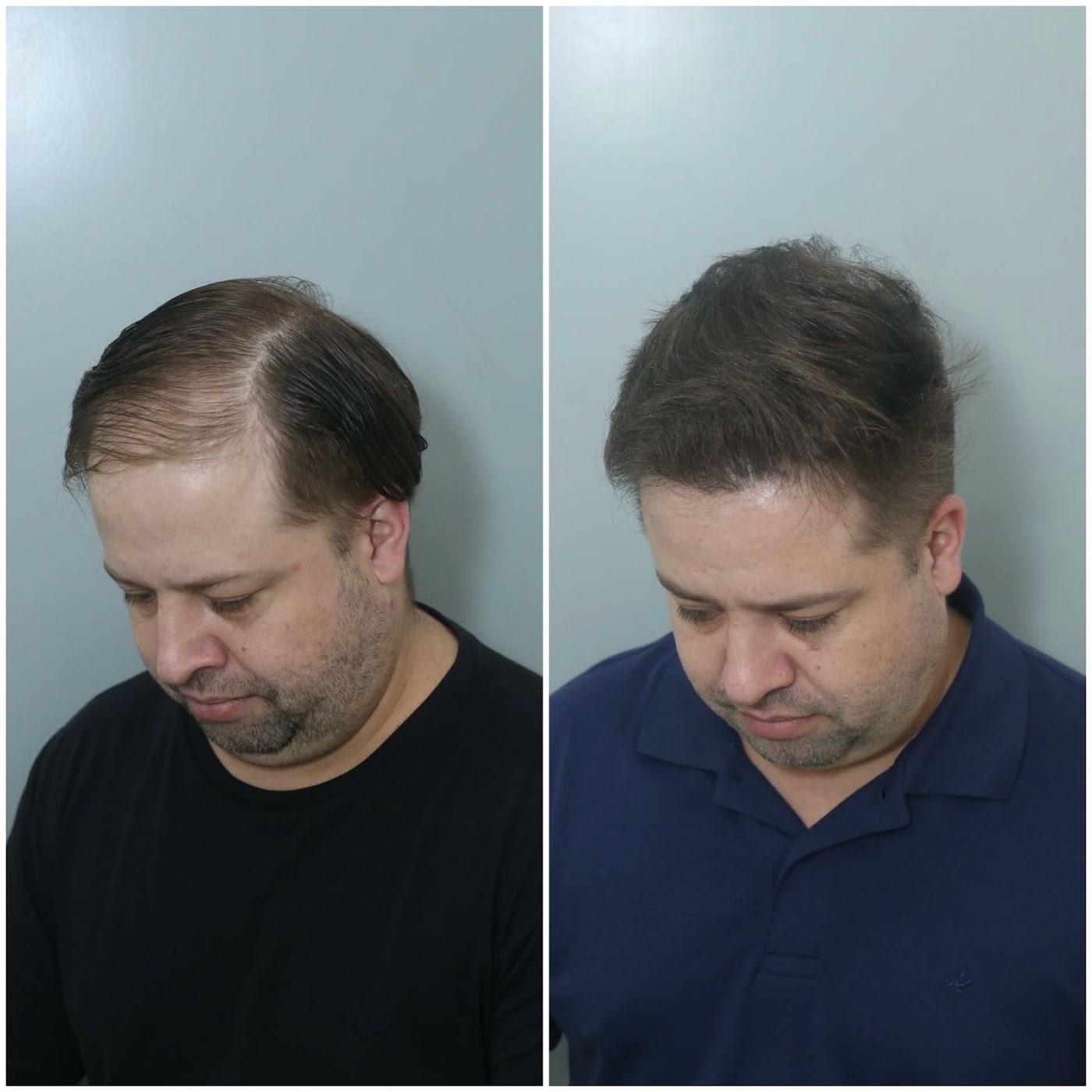 Antes e depois do transplante capilar de Paulo Alfini