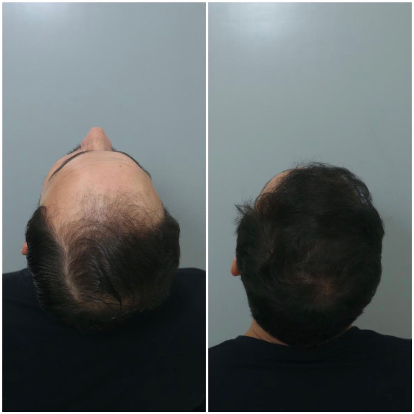 Antes e depois do transplante capilar de Ricardo Granghelli Rodrigues