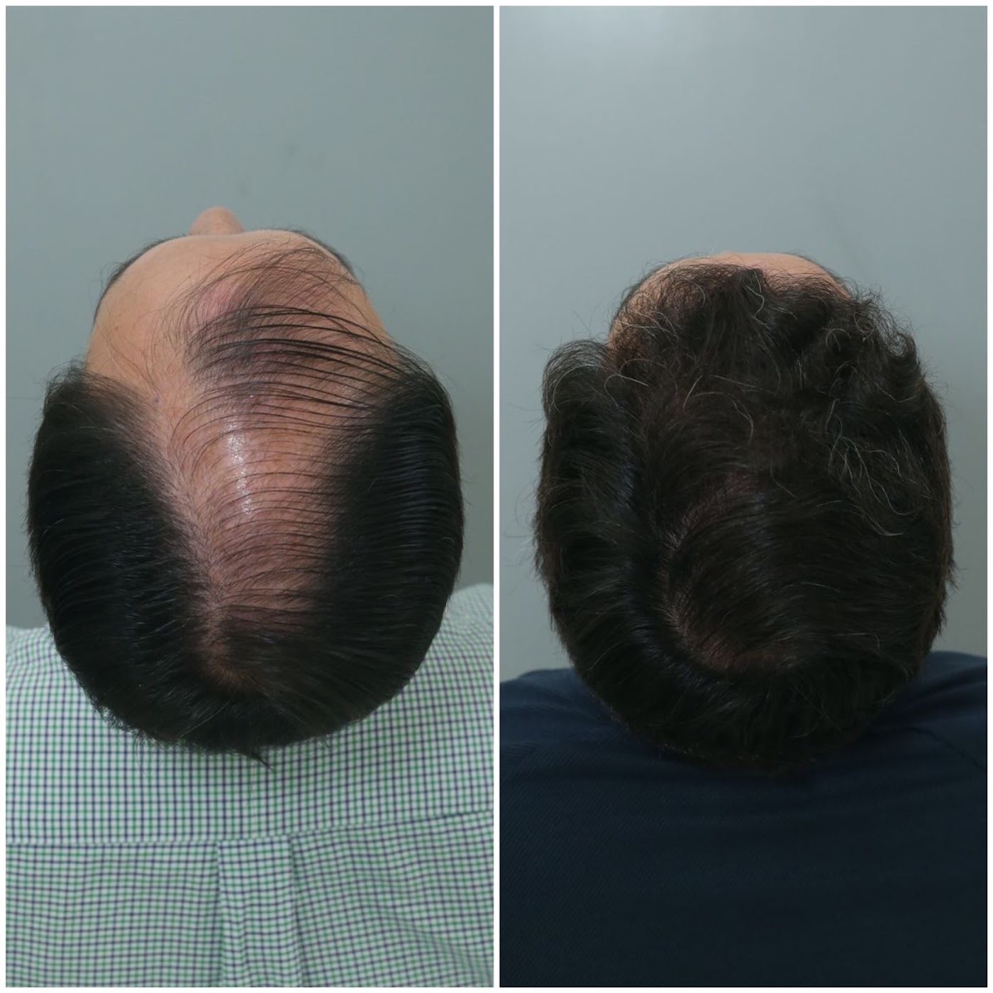 Antes e depois do transplante capilar de Rodrigo Jolig