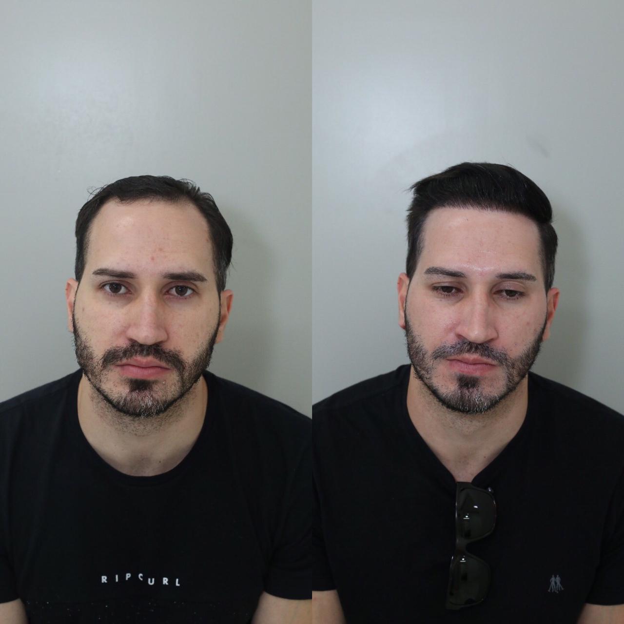 Antes e depois do transplante capilar de Thiago Duque de Sandes