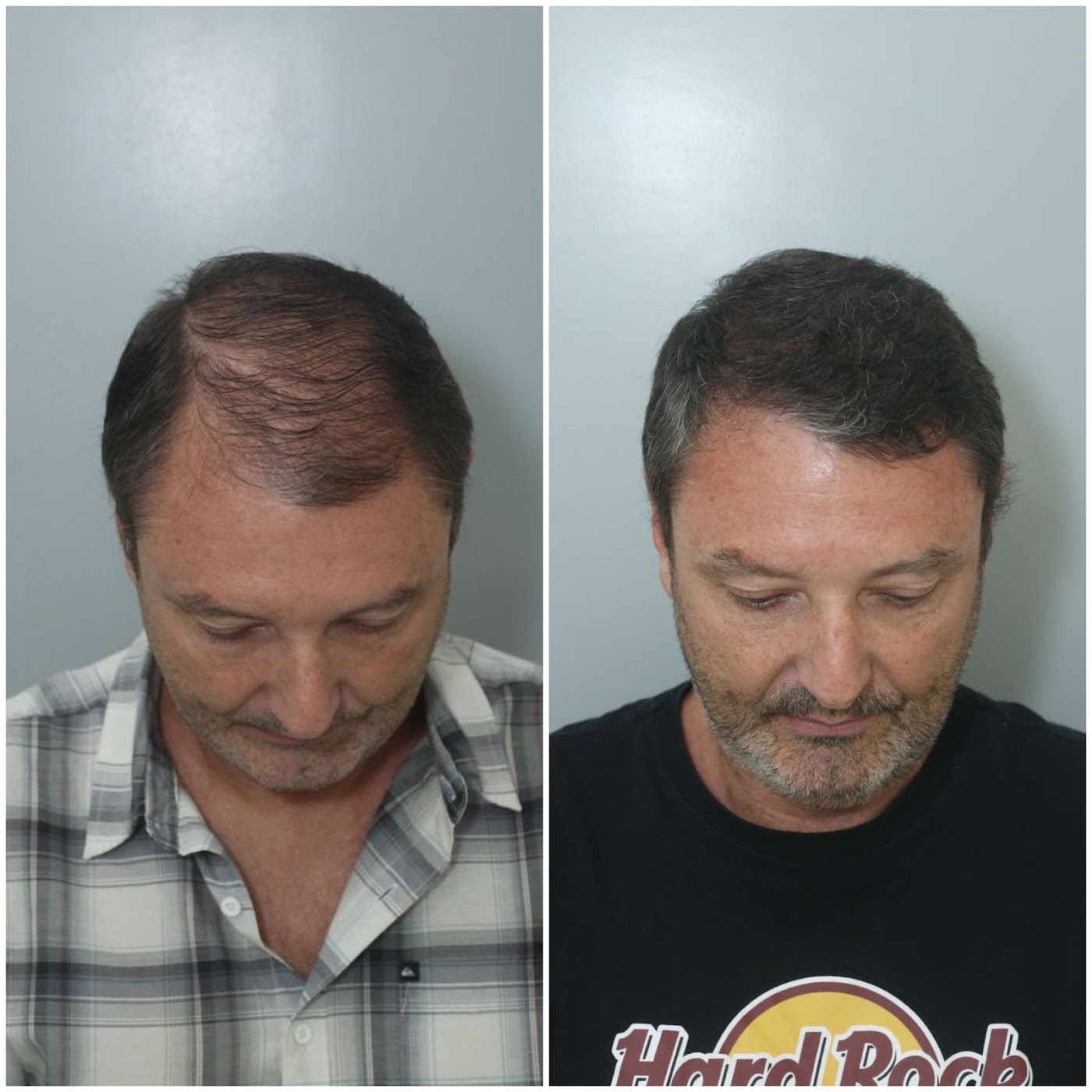 Antes e depois do transplante capilar de Wallace Rodrigues